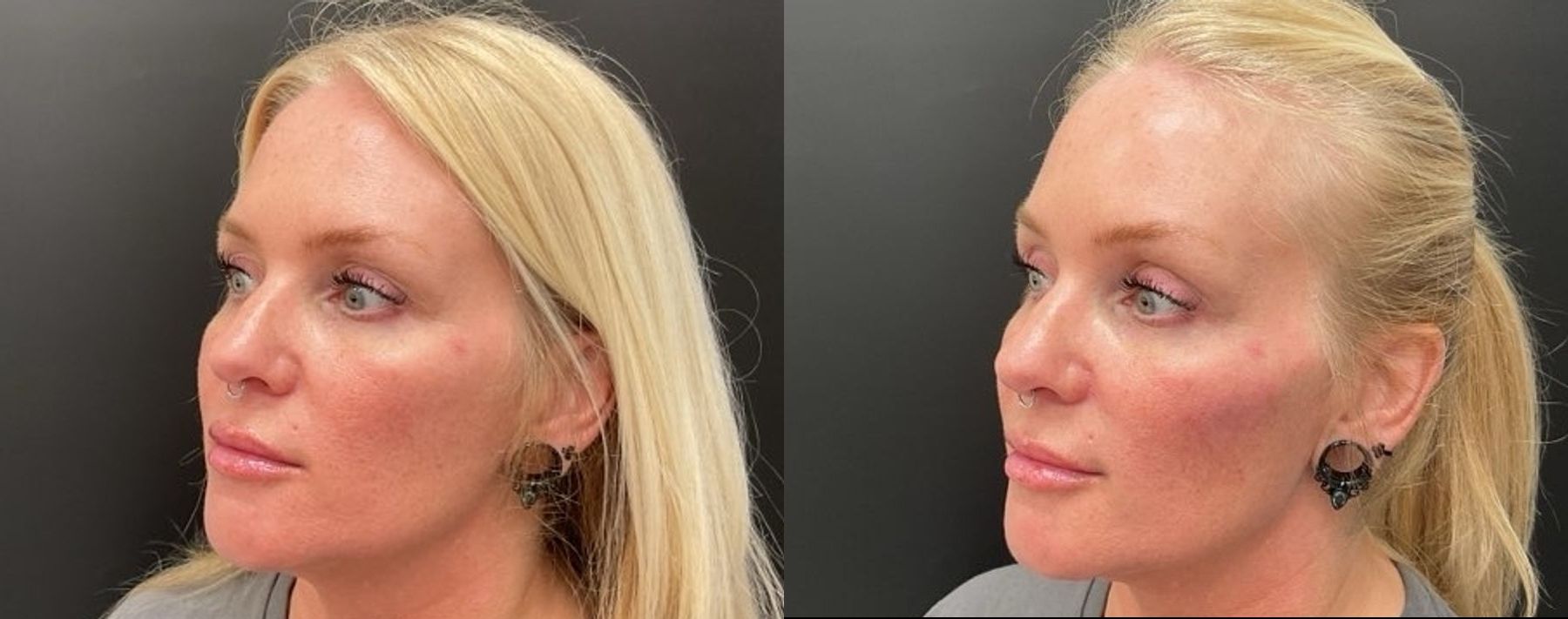 Before and after Filler - Cheeks case 20948 - Angle 3
