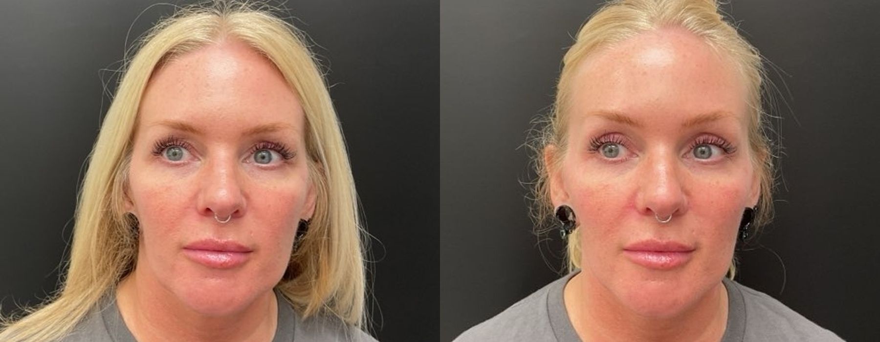 Filler - Cheeks - Case 5347