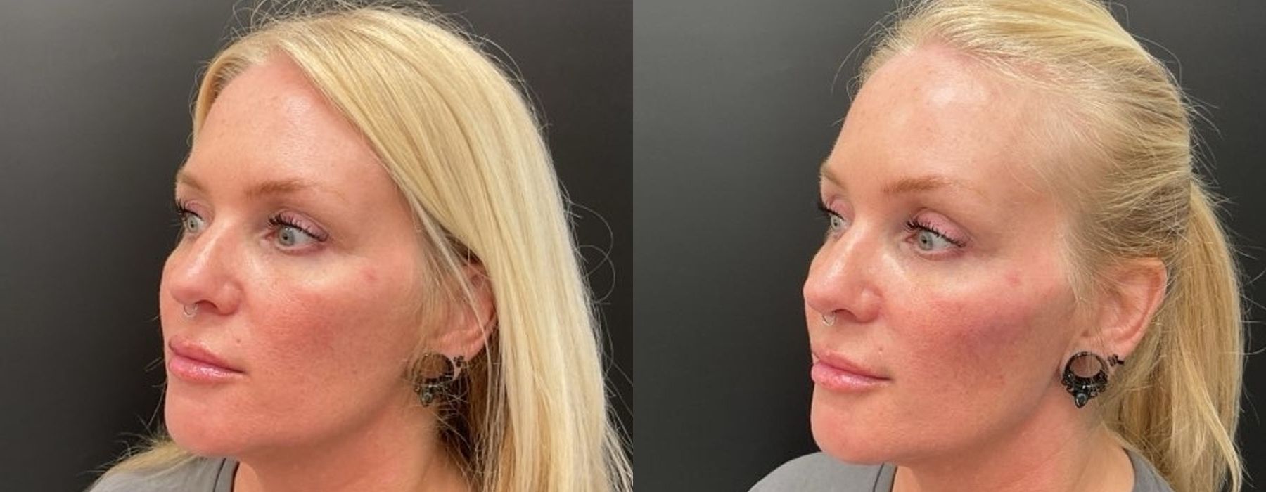 Filler - Cheeks - Thumbnail 3