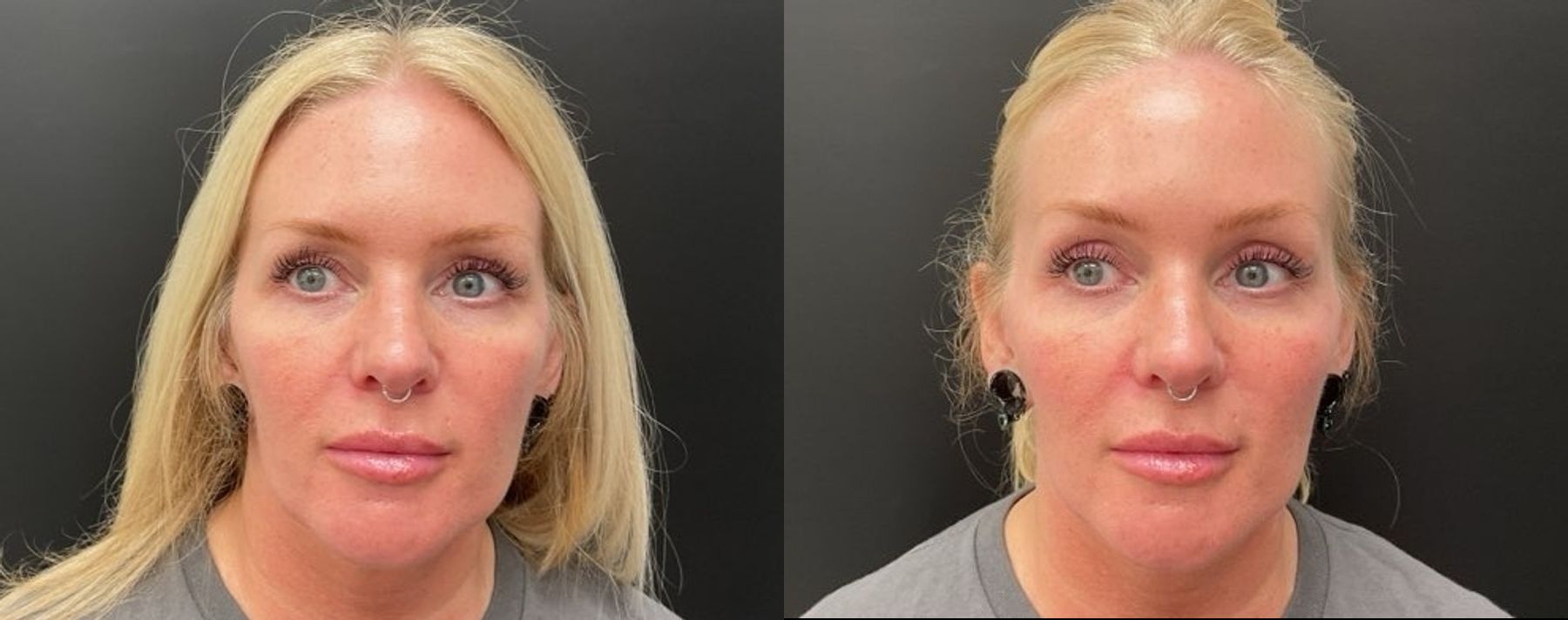 Before and after Filler - Cheeks case 20948