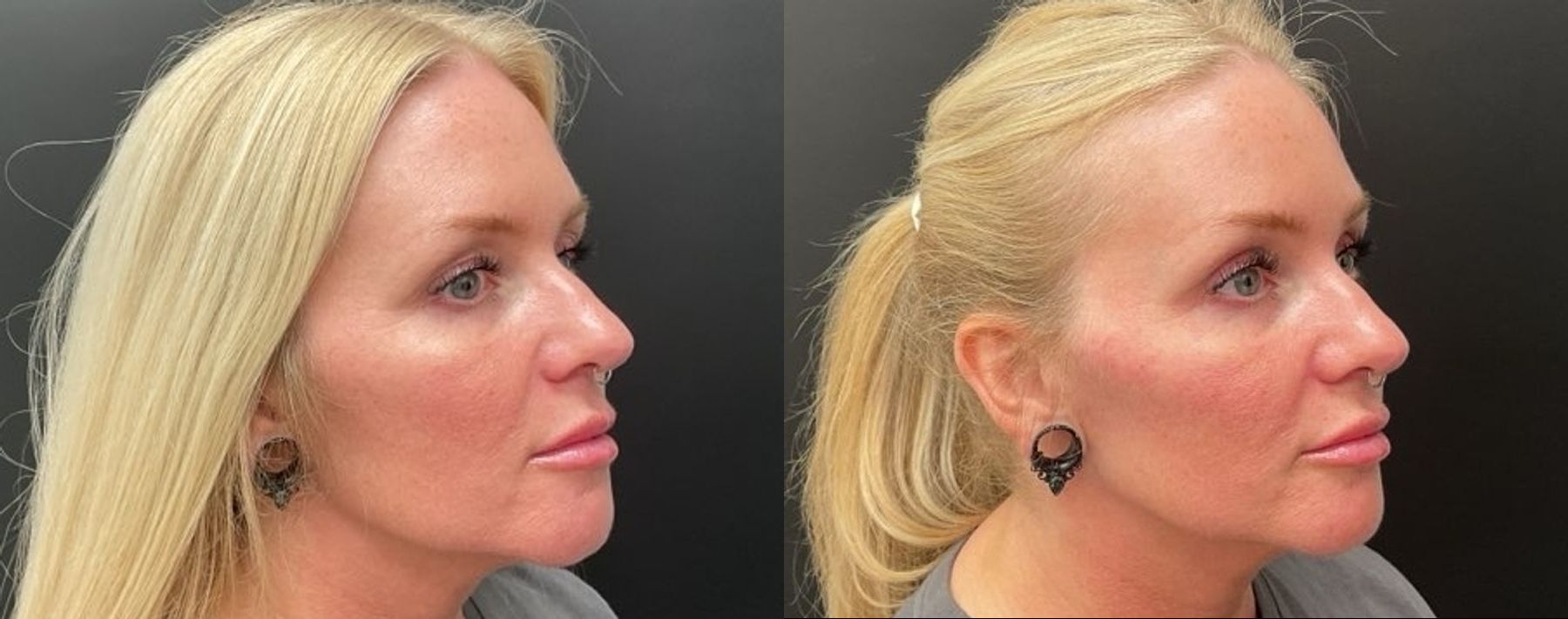 Before and after Filler - Cheeks case 20948 - Angle 2