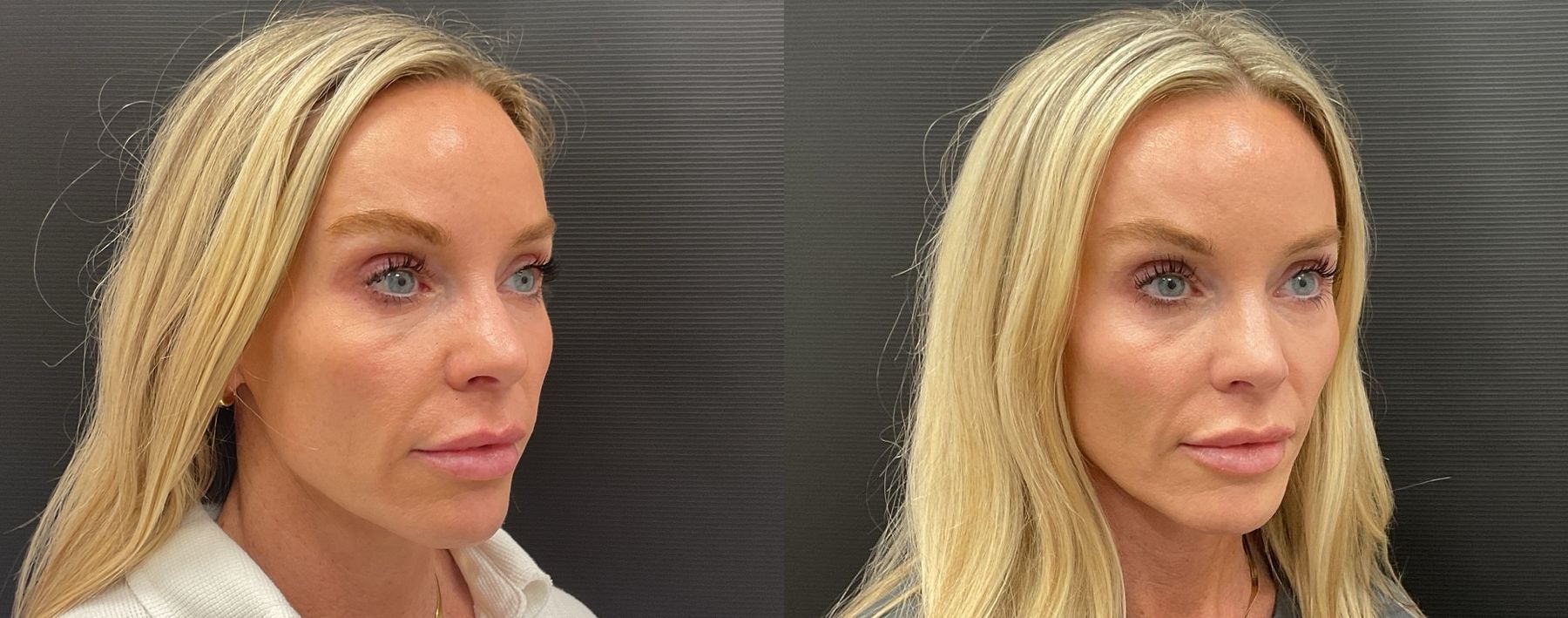 Before and after Filler - Cheeks & Lips case 20949 - Angle 2