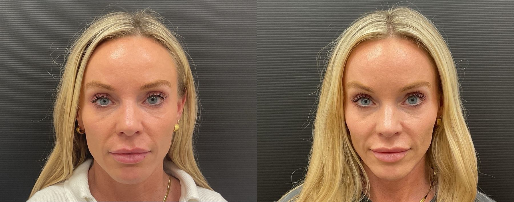 Before and after Filler - Cheeks & Lips case 20949