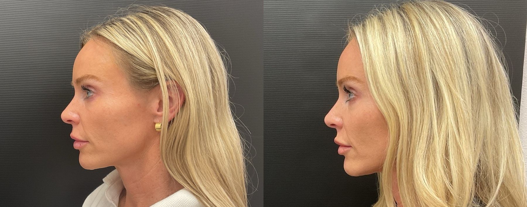 Before and after Filler - Cheeks & Lips case 20949 - Angle 4