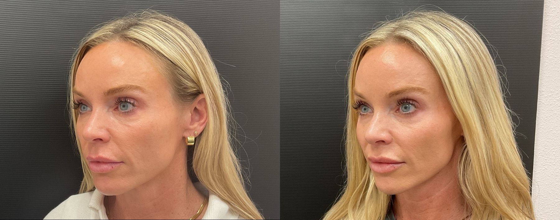 Before and after Filler - Cheeks & Lips case 20949 - Angle 3