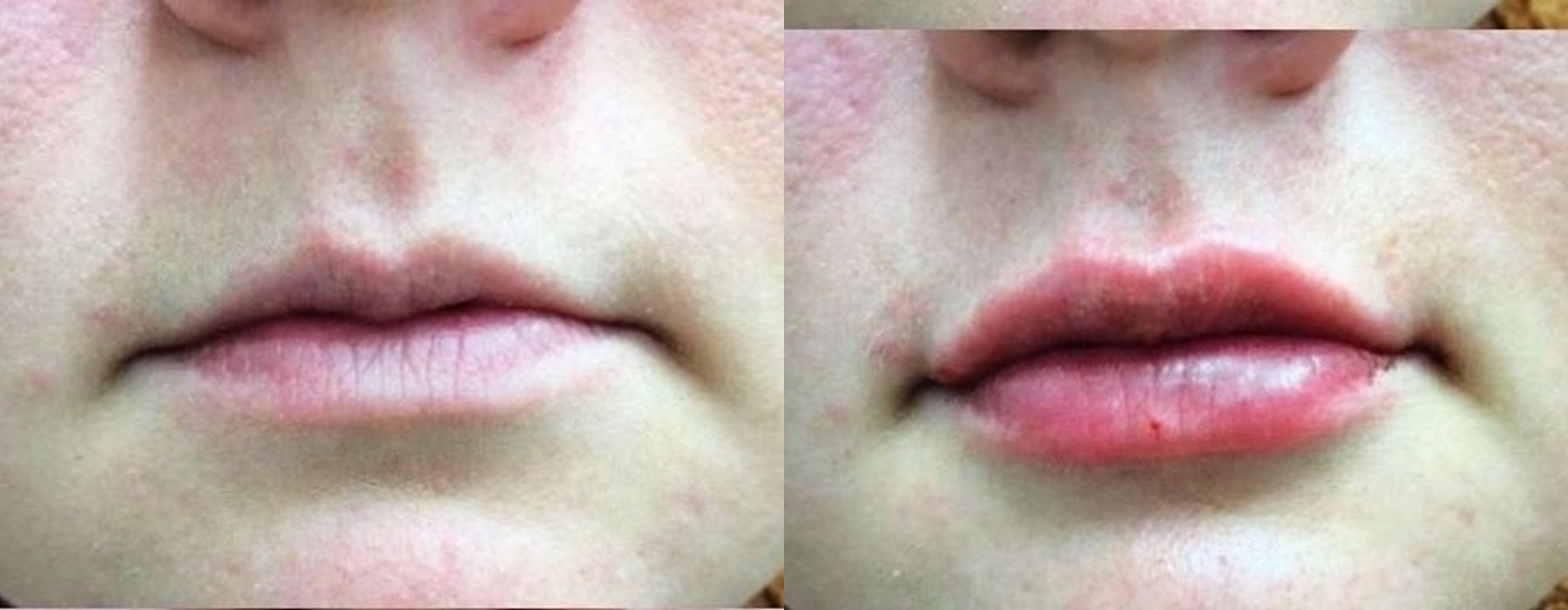 Before and after procedure result