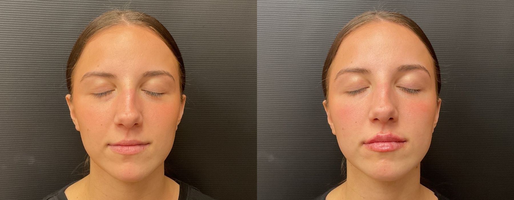 Before and after procedure result