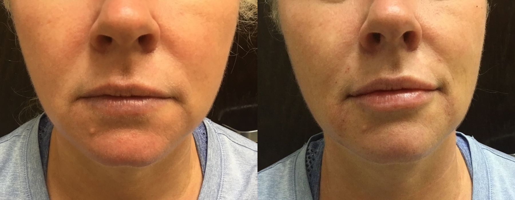 Before and after procedure result