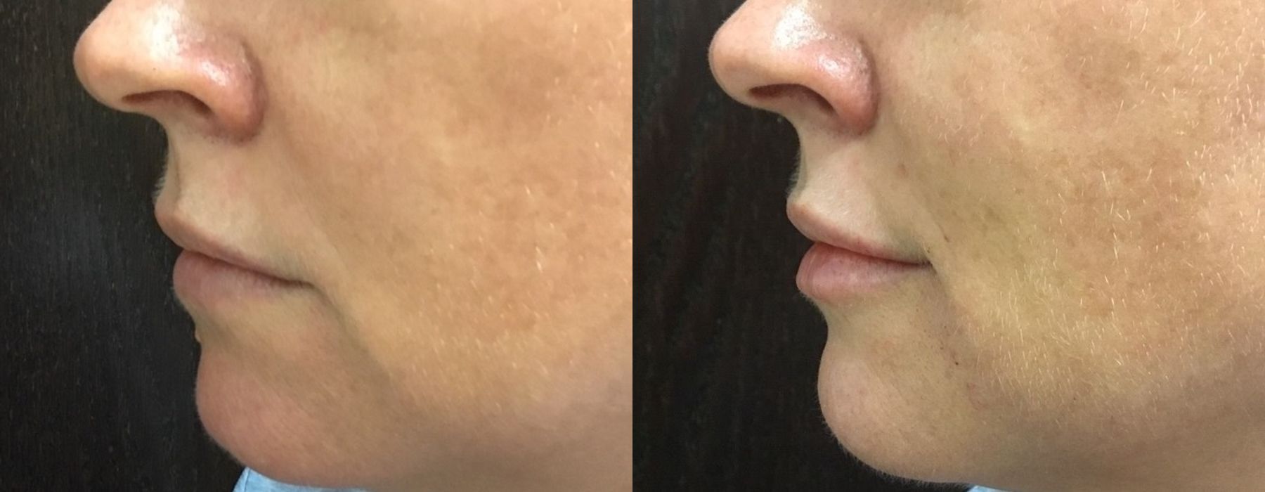 Filler - Lips - Thumbnail 3