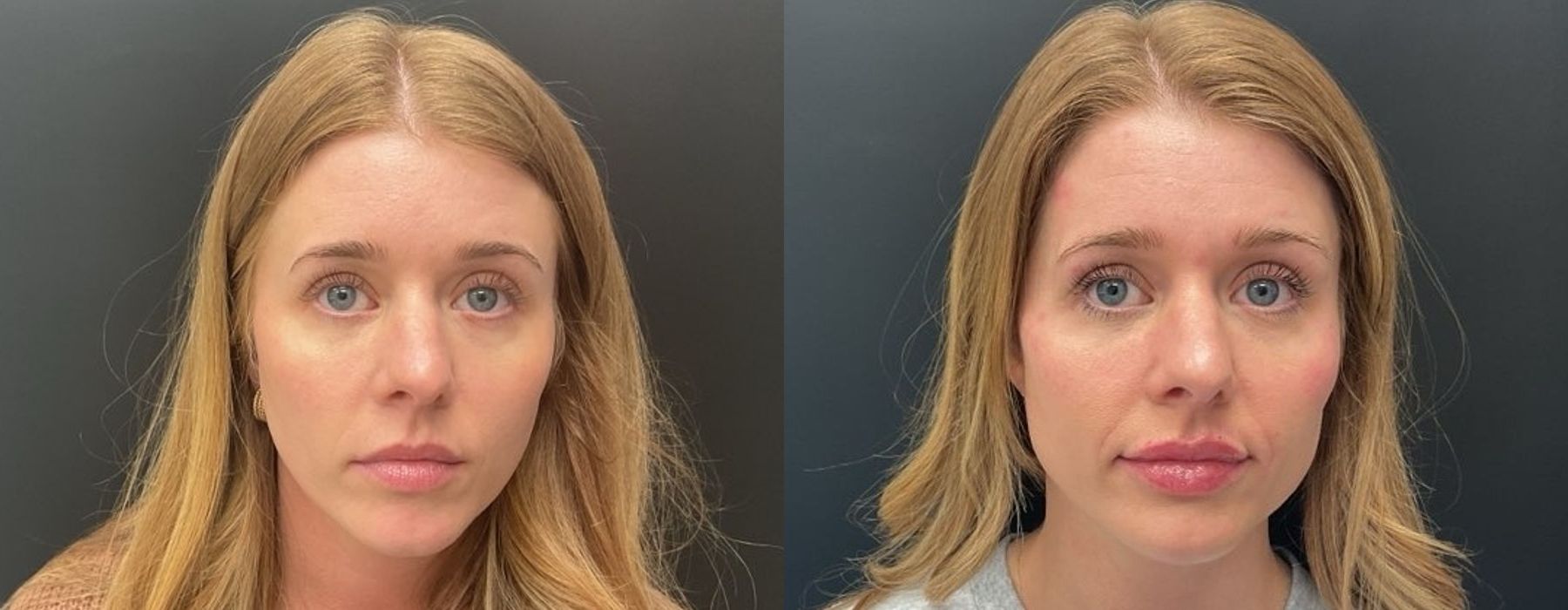Before and after procedure result