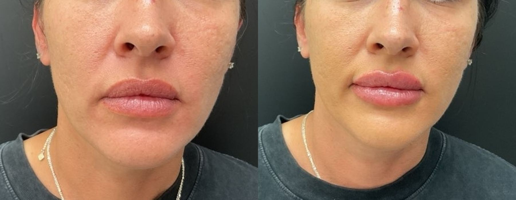 Before and after procedure result