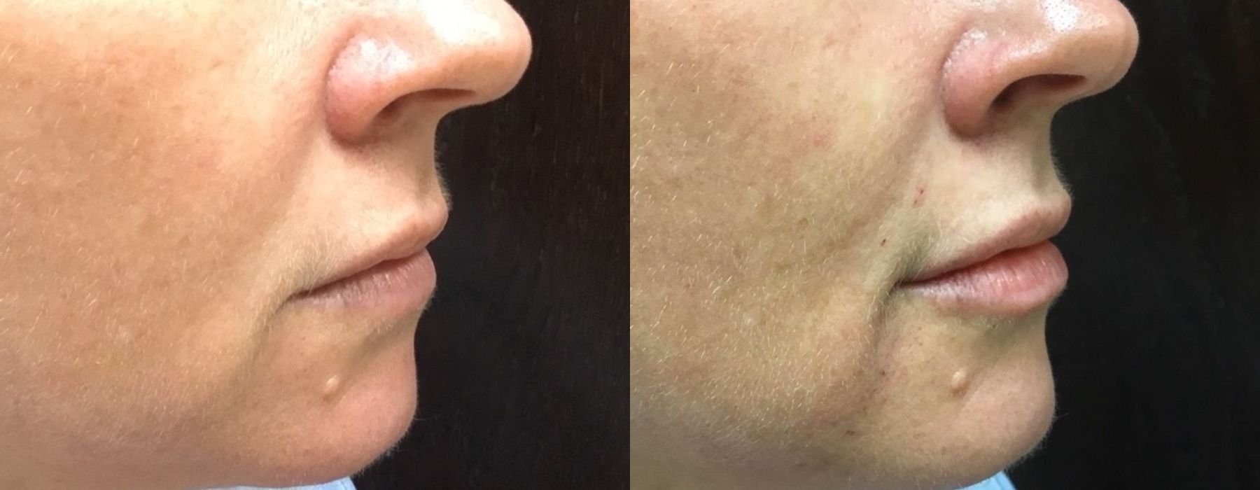 Filler - Lips - Thumbnail 2