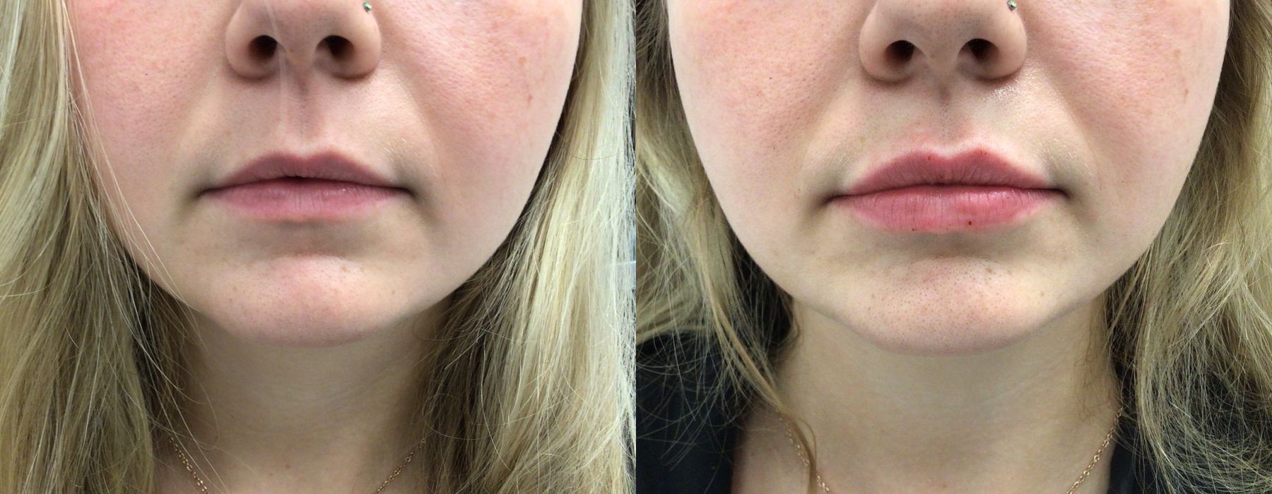 Before and after procedure result