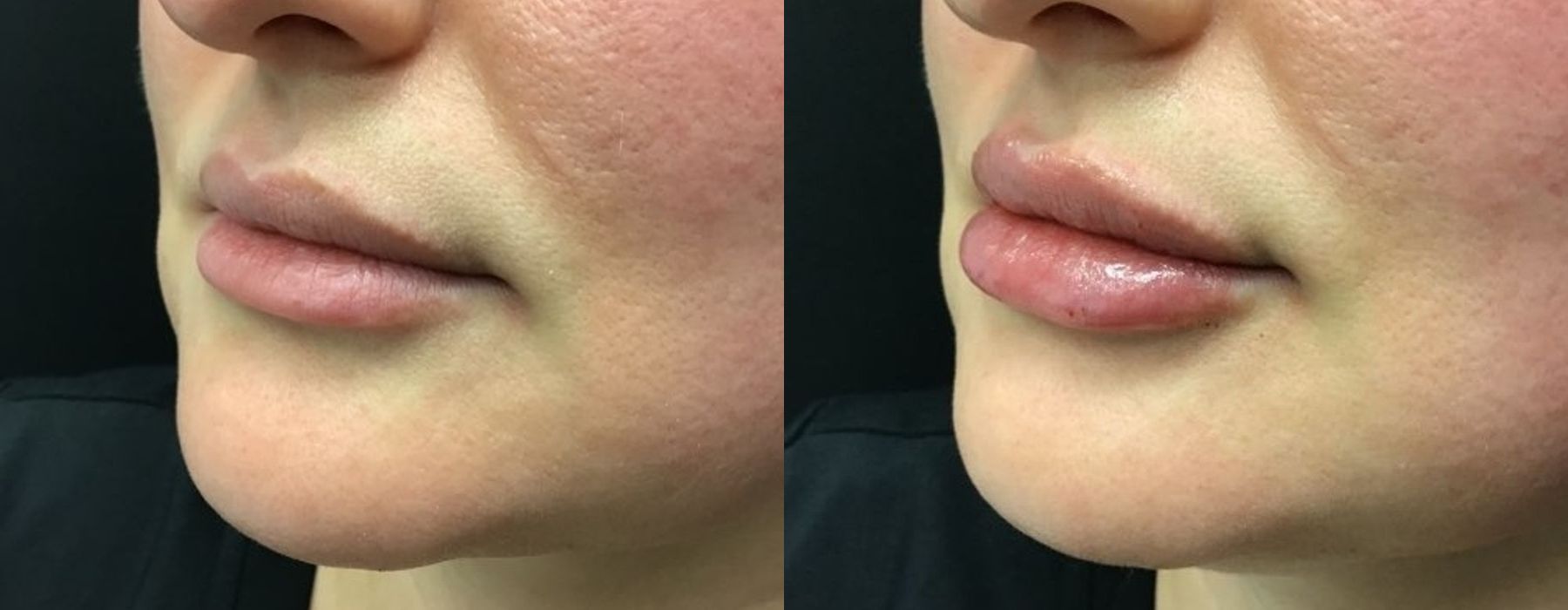 Filler - Lips - Thumbnail 3