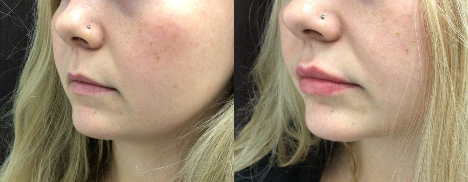 Filler - Lips - Thumbnail 2