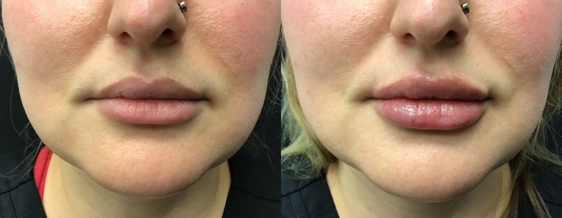 Before and after procedure result