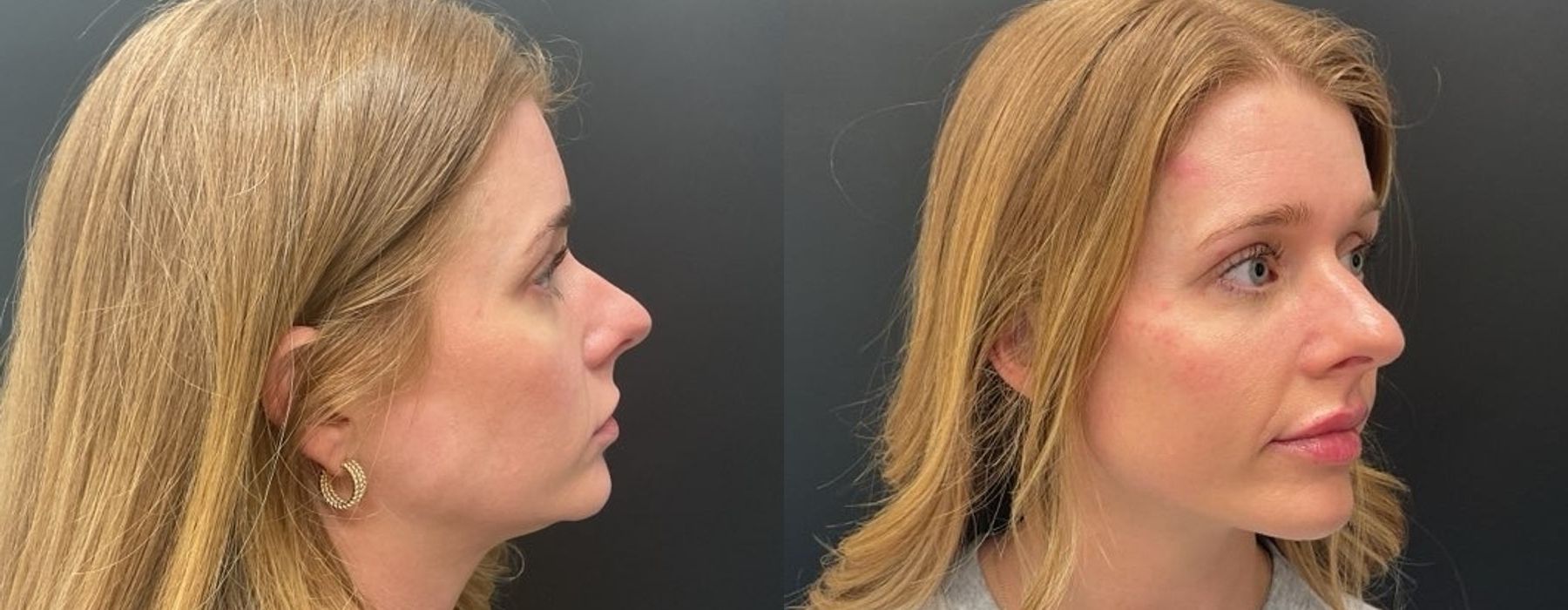 Filler - Lips - Thumbnail 2