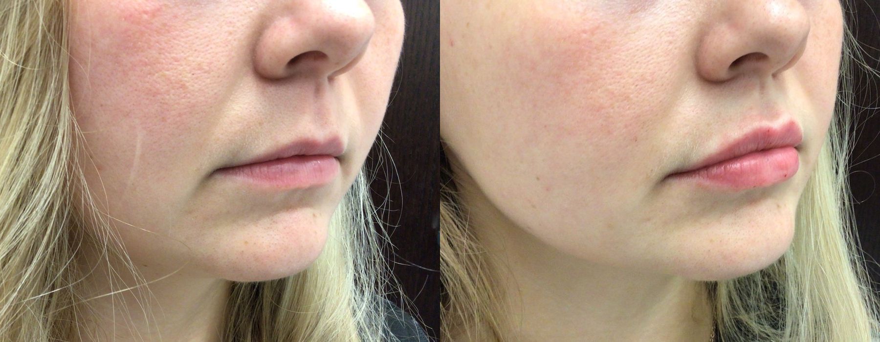 Filler - Lips - Thumbnail 3