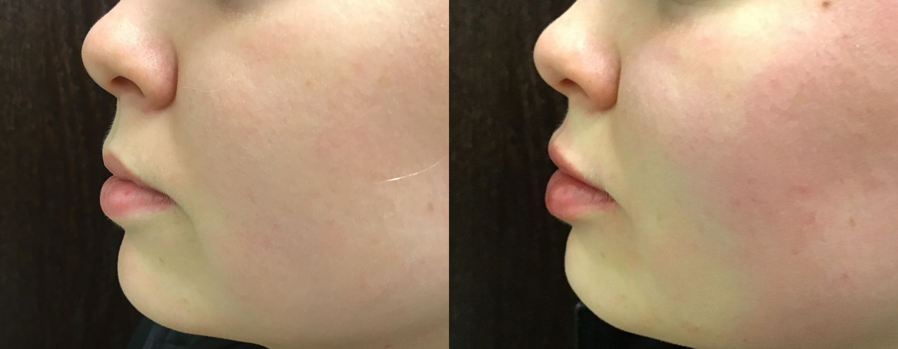 Filler - Lips - Thumbnail 3