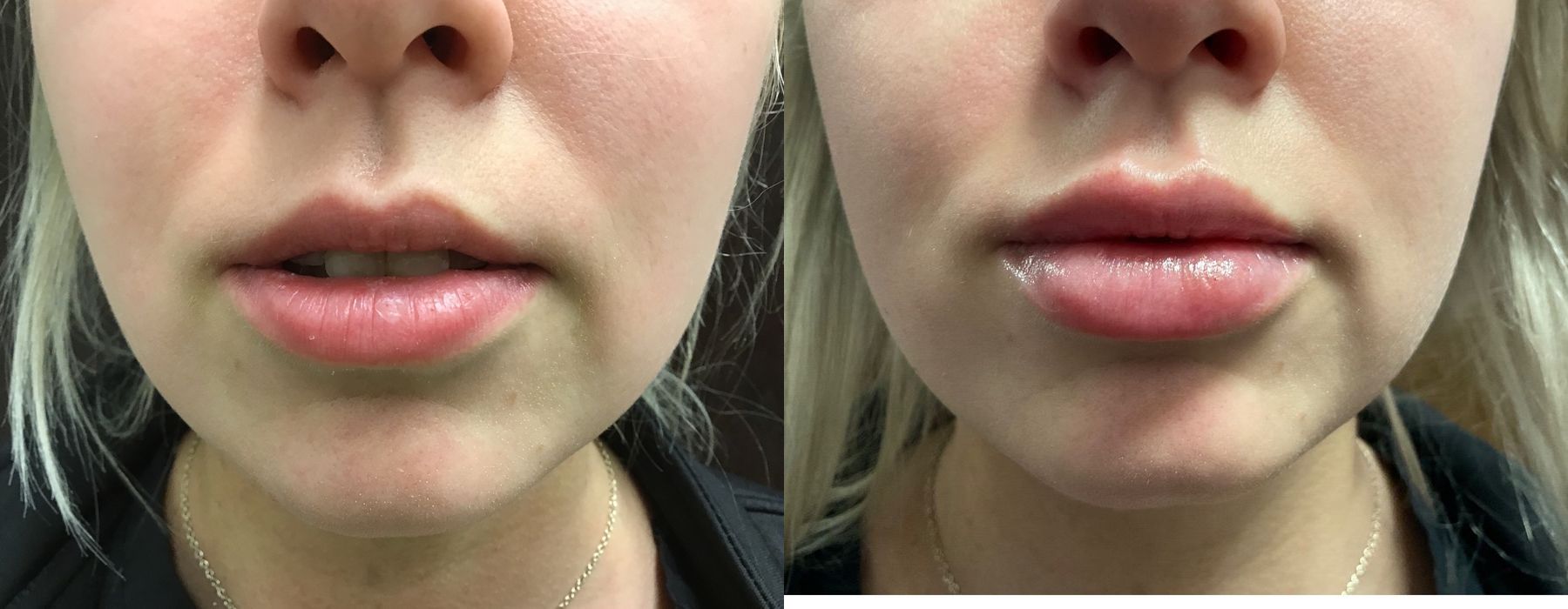 Before and after procedure result