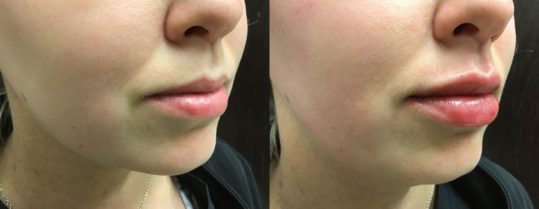 Filler - Lips - Thumbnail 2