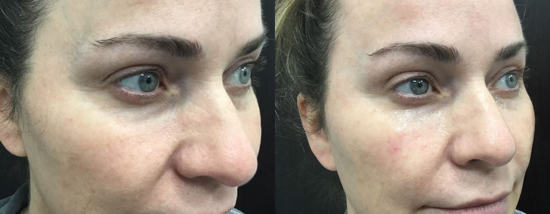 Filler - Tear Trough - Thumbnail 2