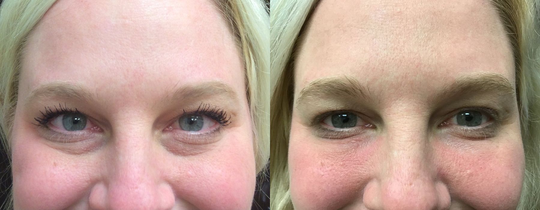 Filler - Tear Trough - Case 5356