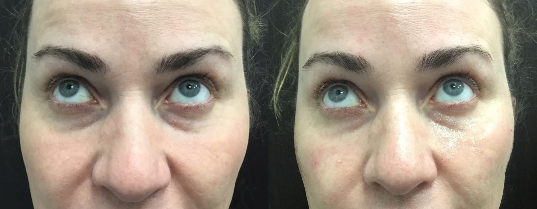 Filler - Tear Trough - Thumbnail 3