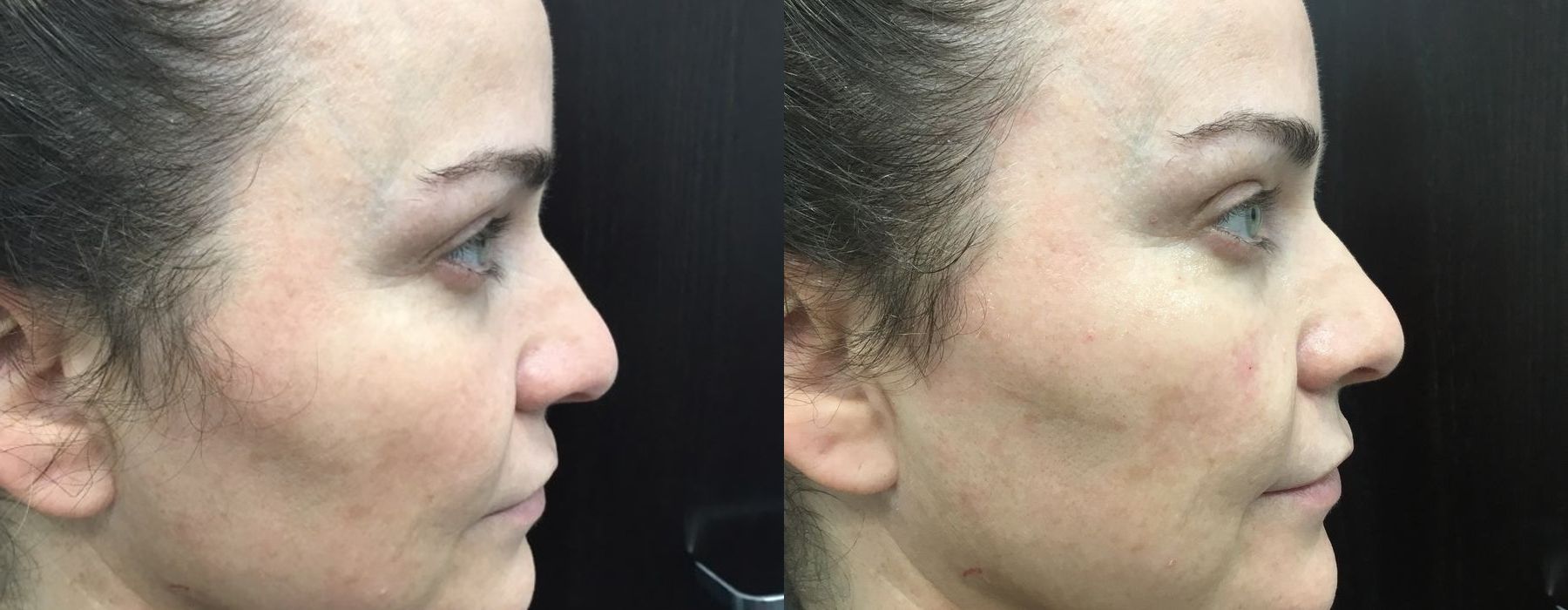 Filler - Tear Trough - Case 5357