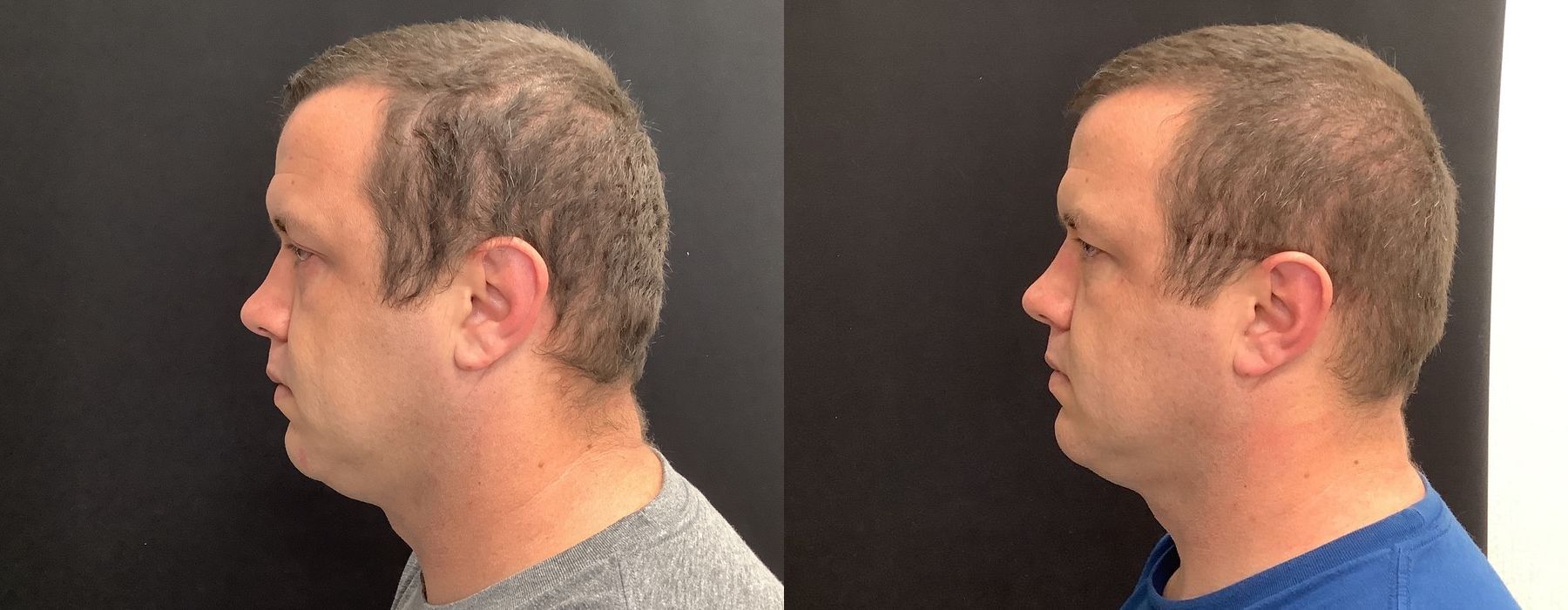 Genius RF Microneedling - Thumbnail 5