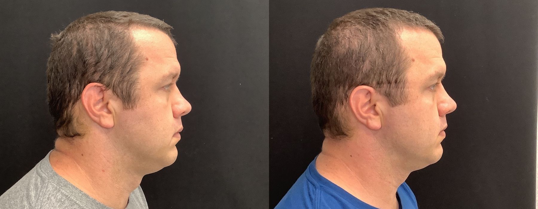 Genius RF Microneedling - Thumbnail 3