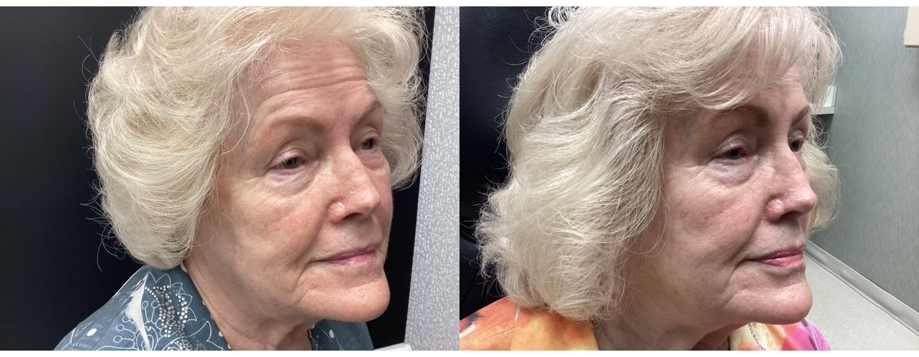 Genius RF Microneedling - Thumbnail 3