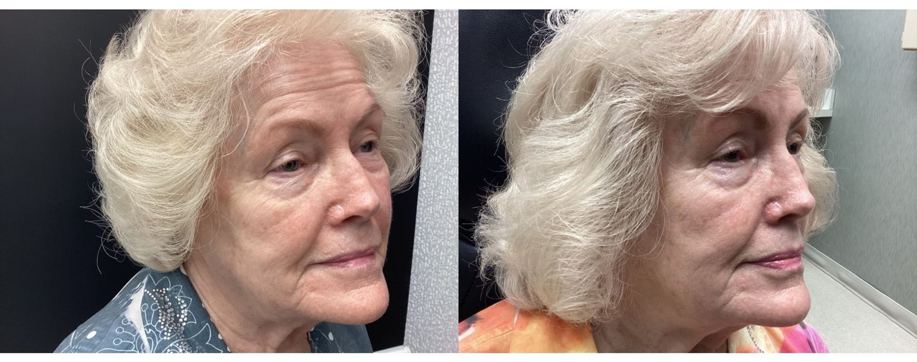 Before and after Genius RF Microneedling case 20942 - Angle 3