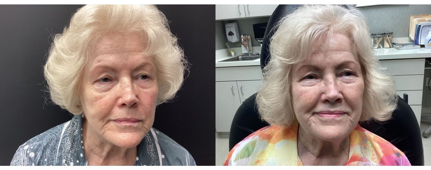Before and after Genius RF Microneedling case 20942