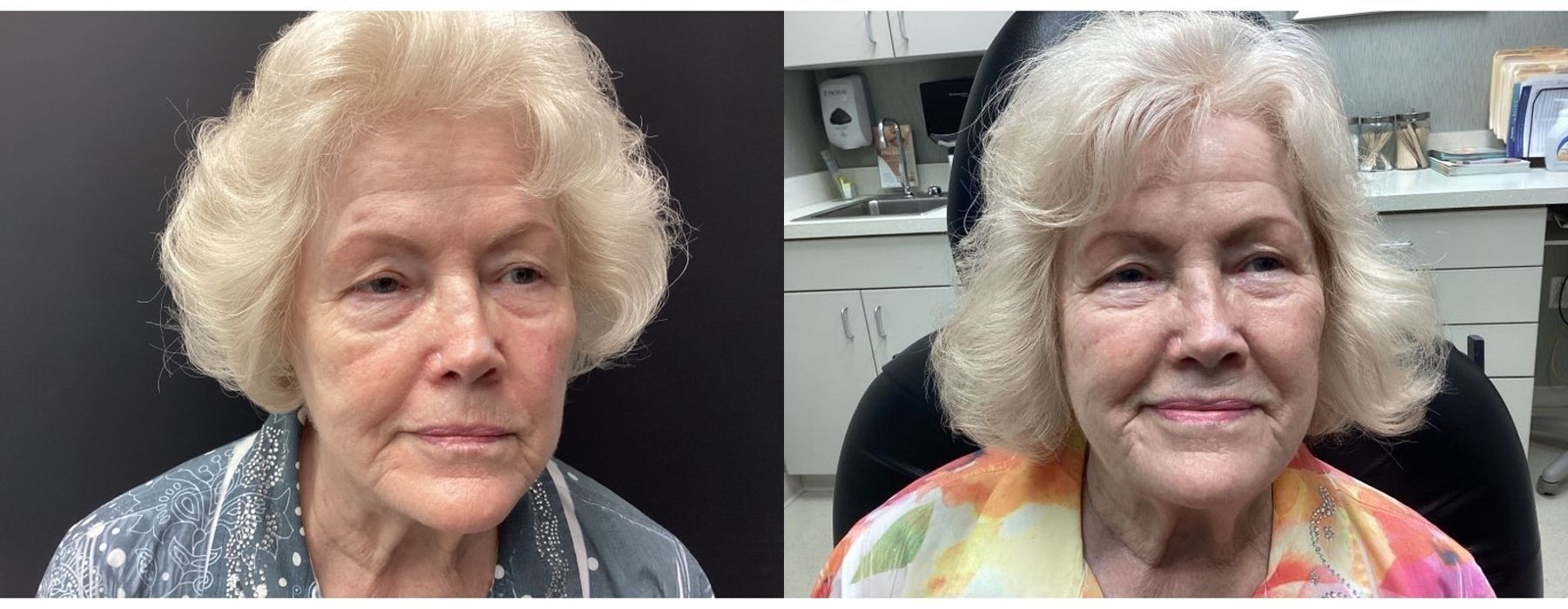 Genius RF Microneedling - Case 5316