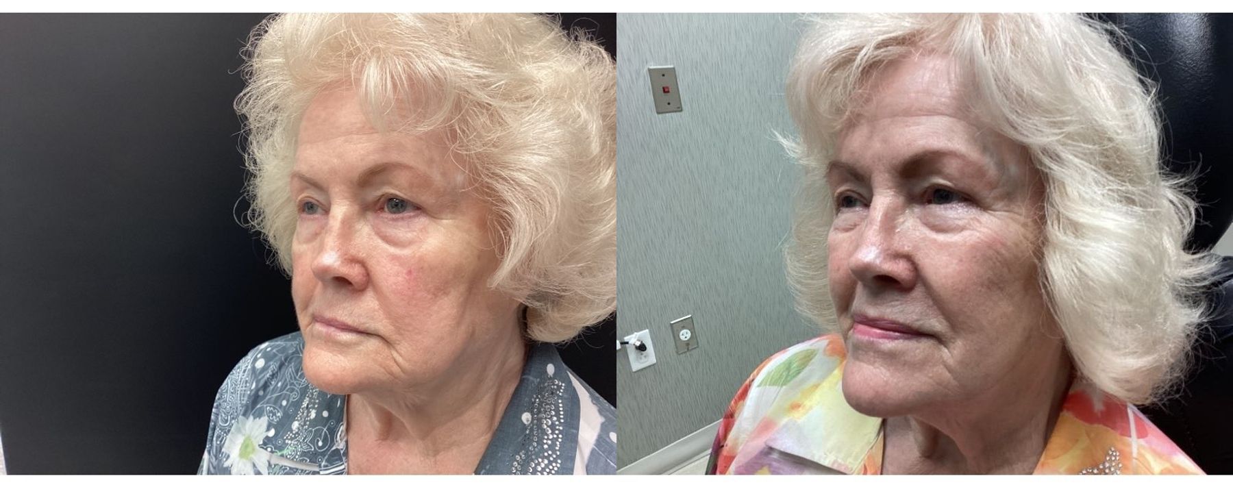 Before and after Genius RF Microneedling case 20942 - Angle 2