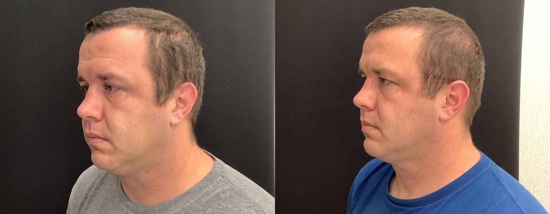 Genius RF Microneedling - Thumbnail 4