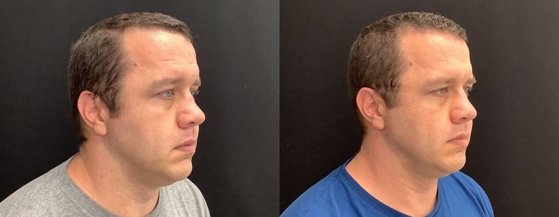 Genius RF Microneedling - Thumbnail 2