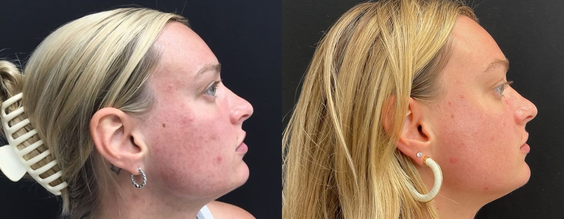 Laser - AviClear - Thumbnail 3