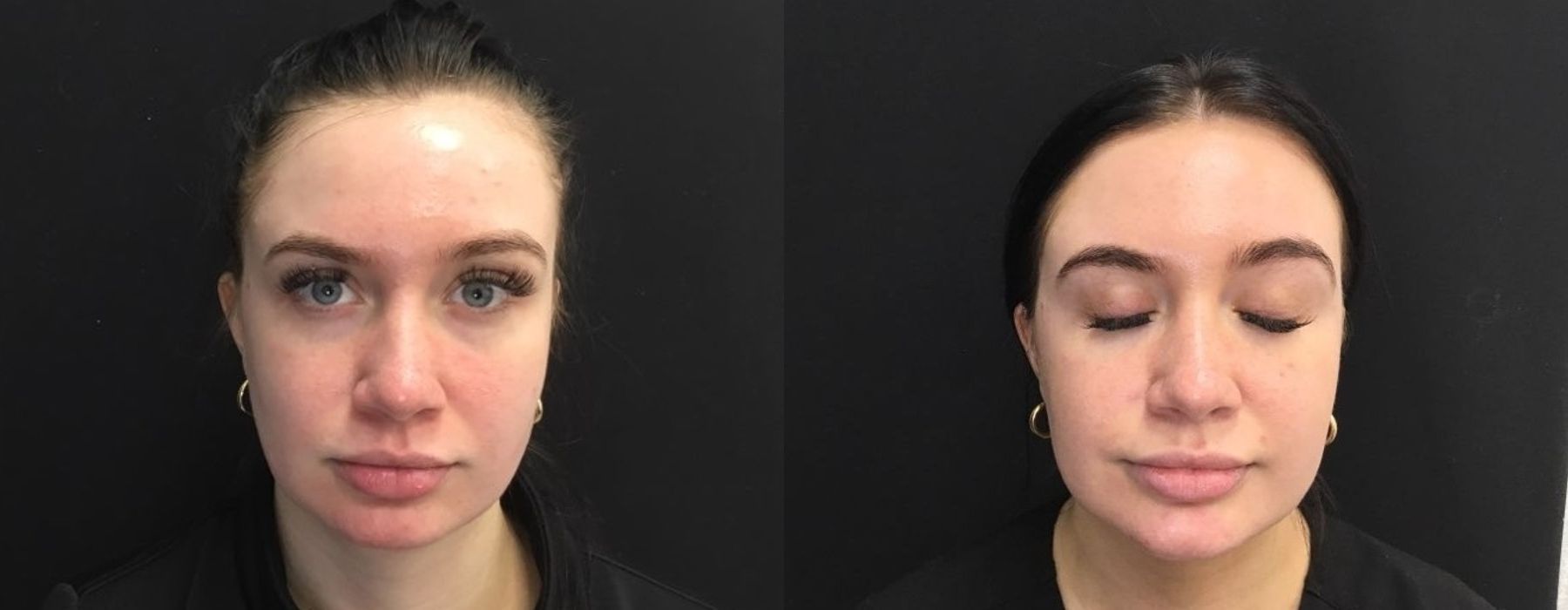 Laser - AviClear - Case 5317