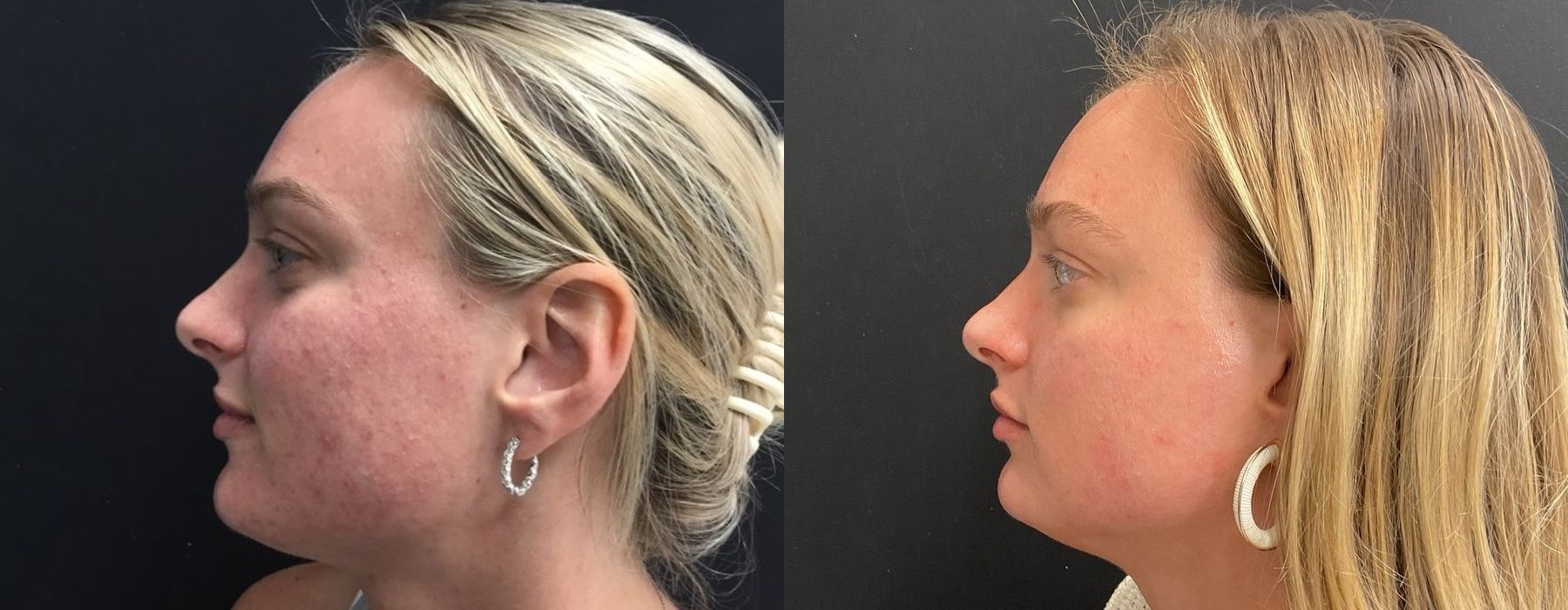 Laser - AviClear - Thumbnail 2