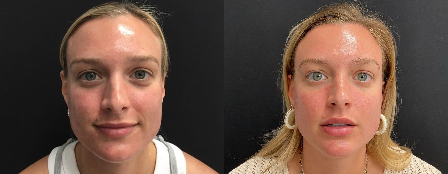 Laser - AviClear - Case 5318