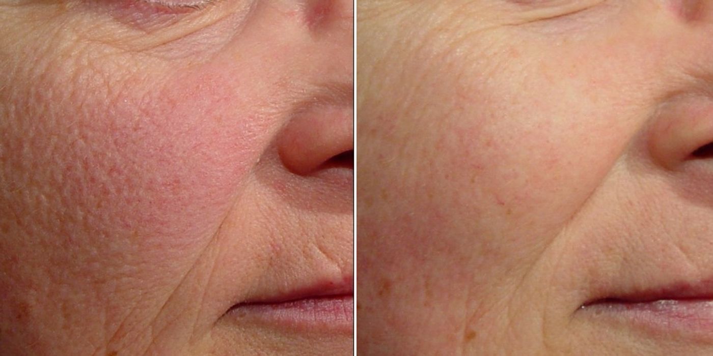 Laser Genesis - Case 5326