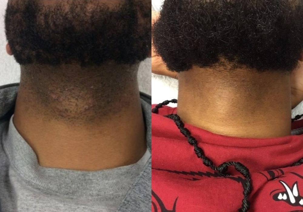 Laser Hair Removal - Case 5295