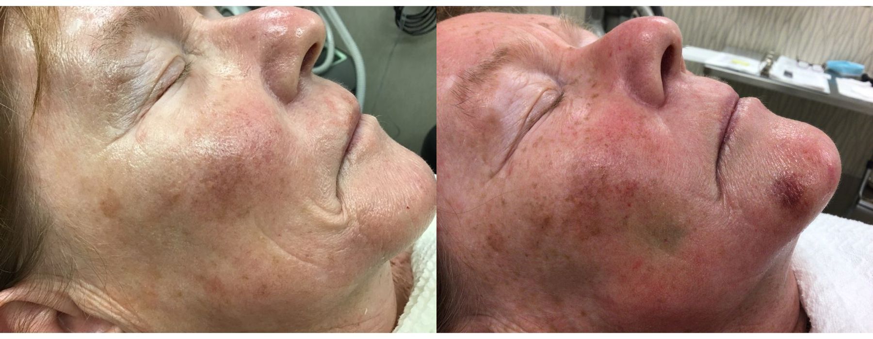 Laser - Pearl - Thumbnail 3