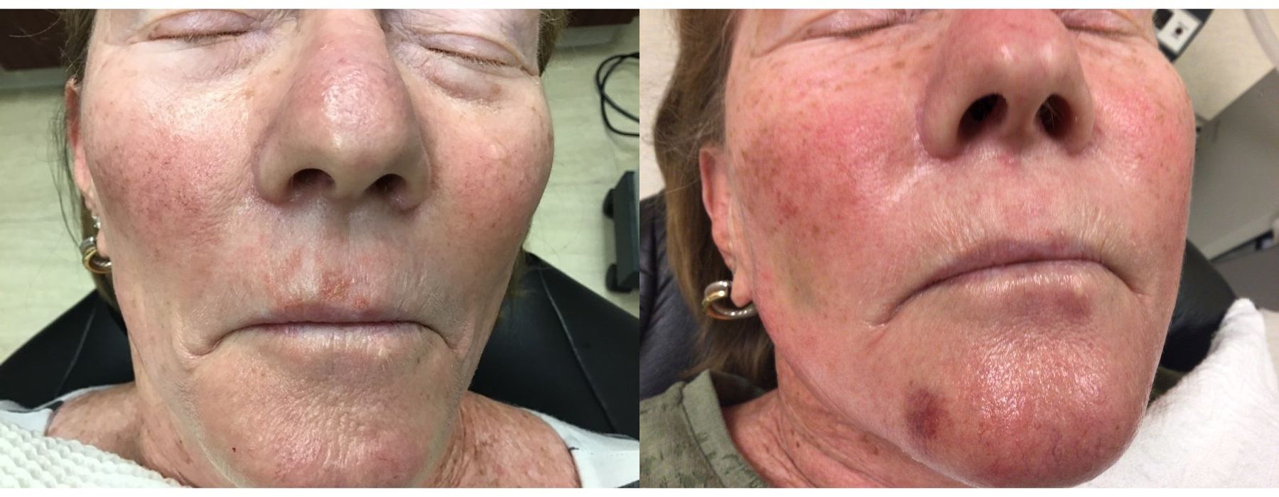 Laser - Pearl - Case 5319