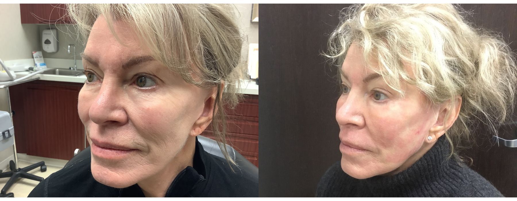 Laser - Pearl - Case 5320