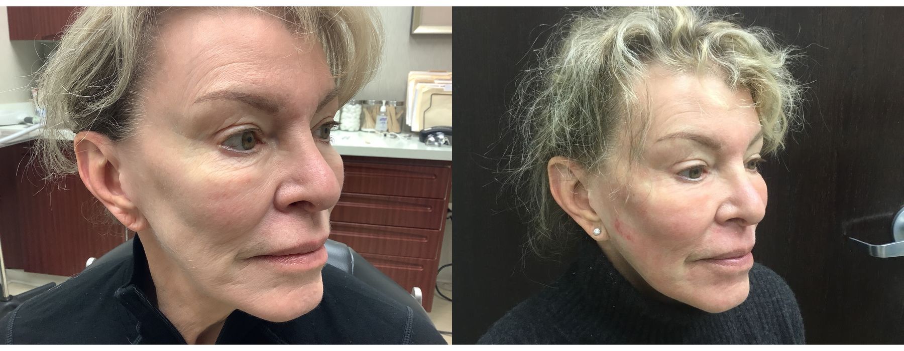 Laser - Pearl - Thumbnail 2