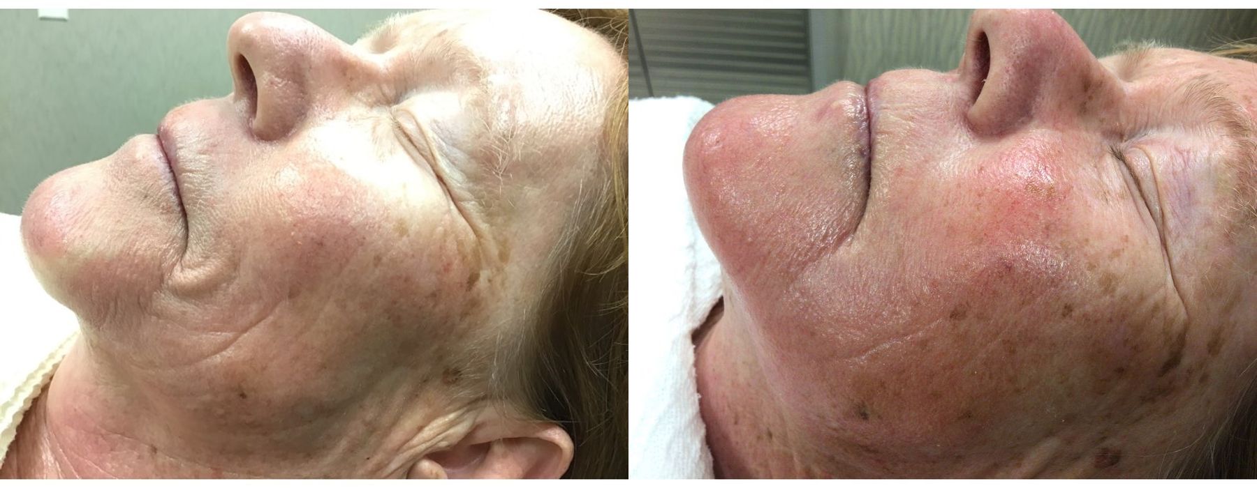 Laser - Pearl - Thumbnail 2