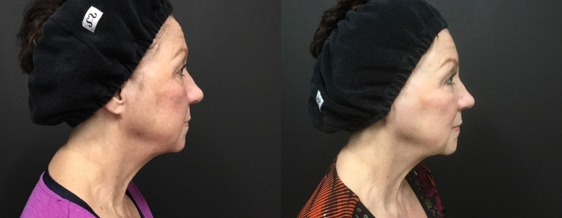 Laser - Pico Genesis - Case 5321